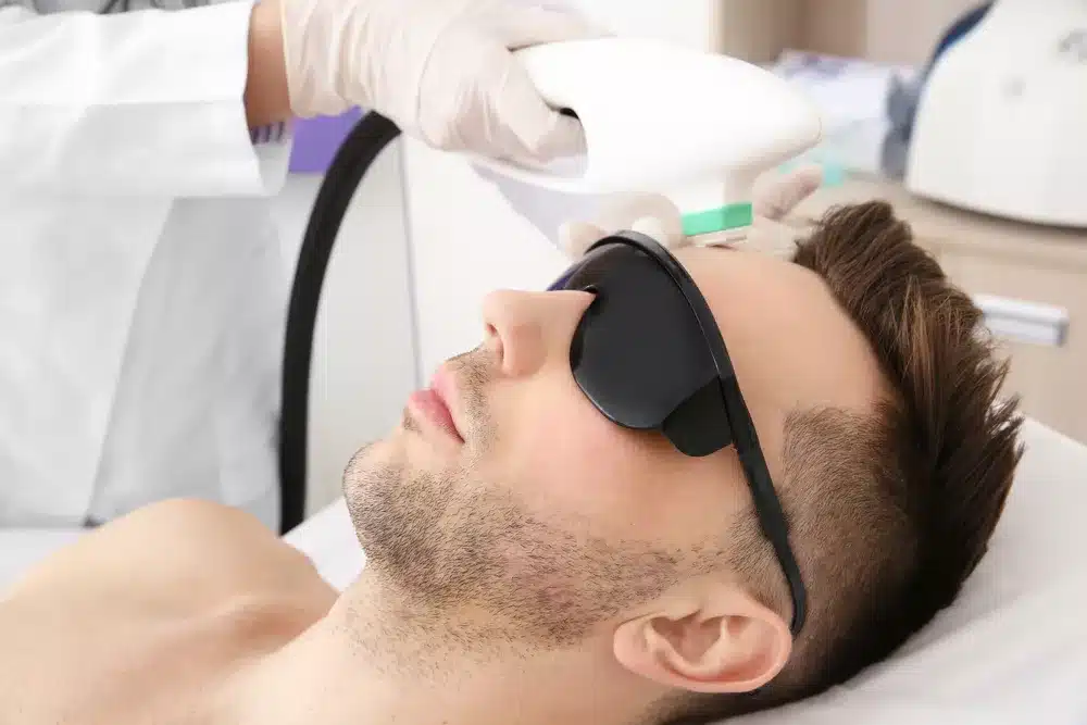 eyebrow laser hair removal for men