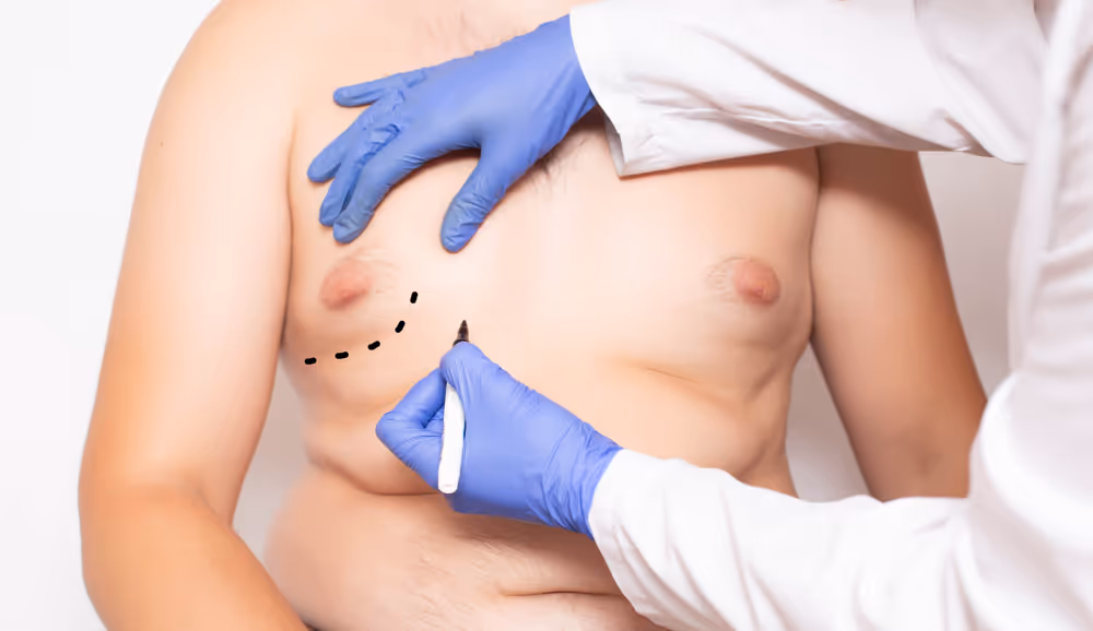 male breast coolsculpting toronto