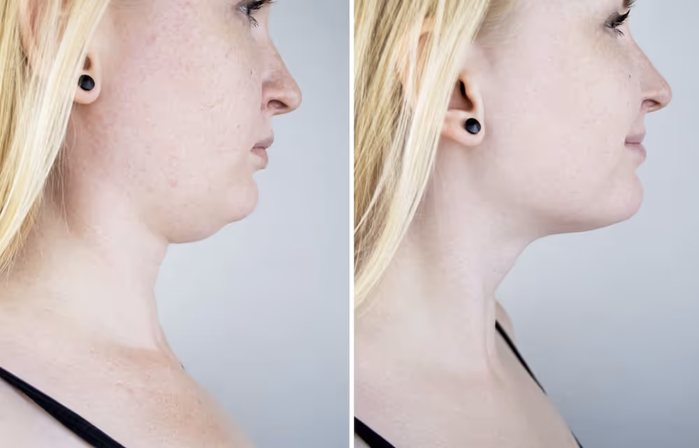 coolsculpting chin before and after