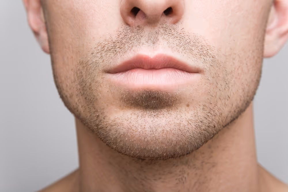 coolsculpting chin for men