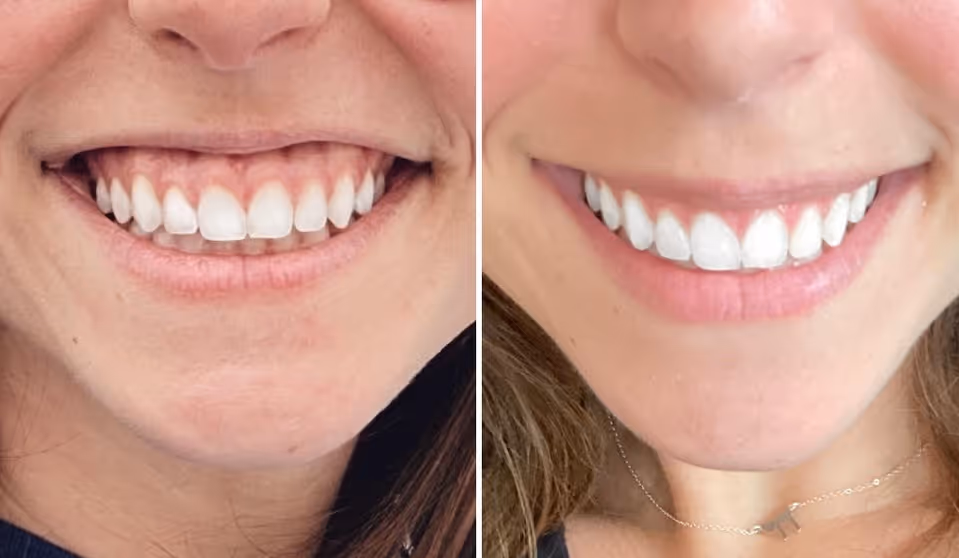 gummy smile botox before and after