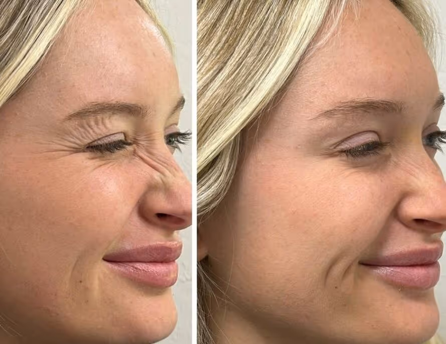 botox bunny lines before and after