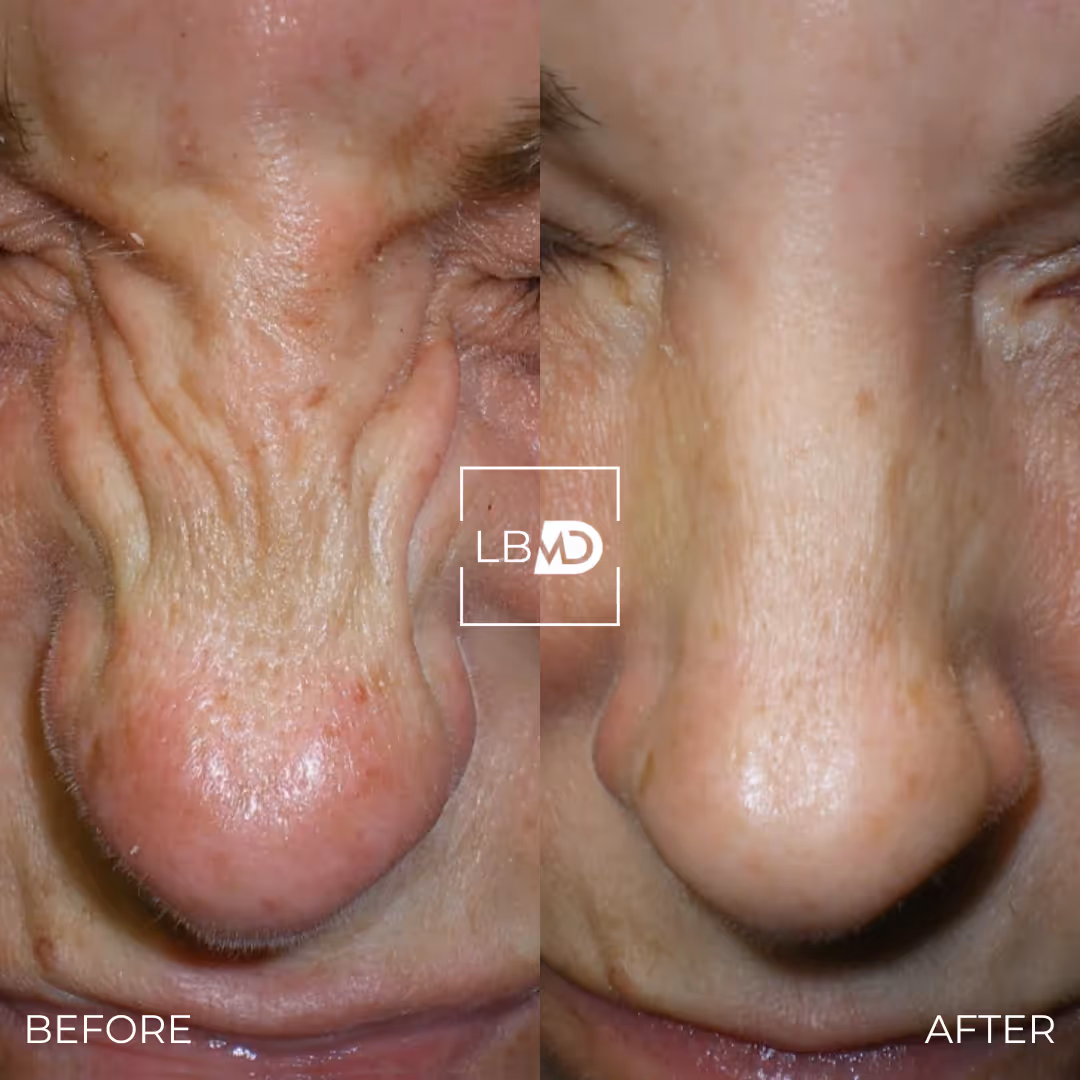 botox bunny lines before and after