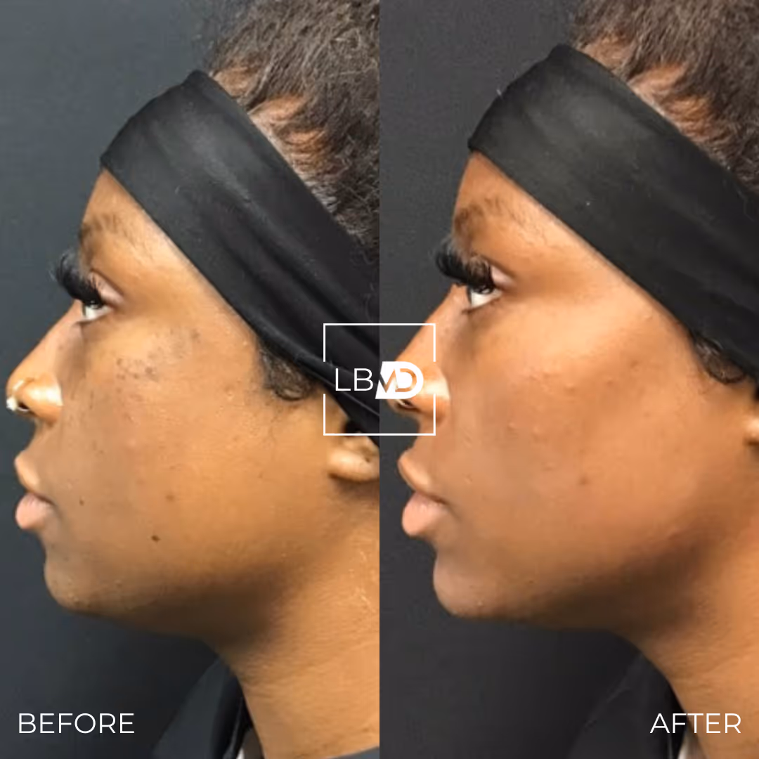 laser hair removal before and after