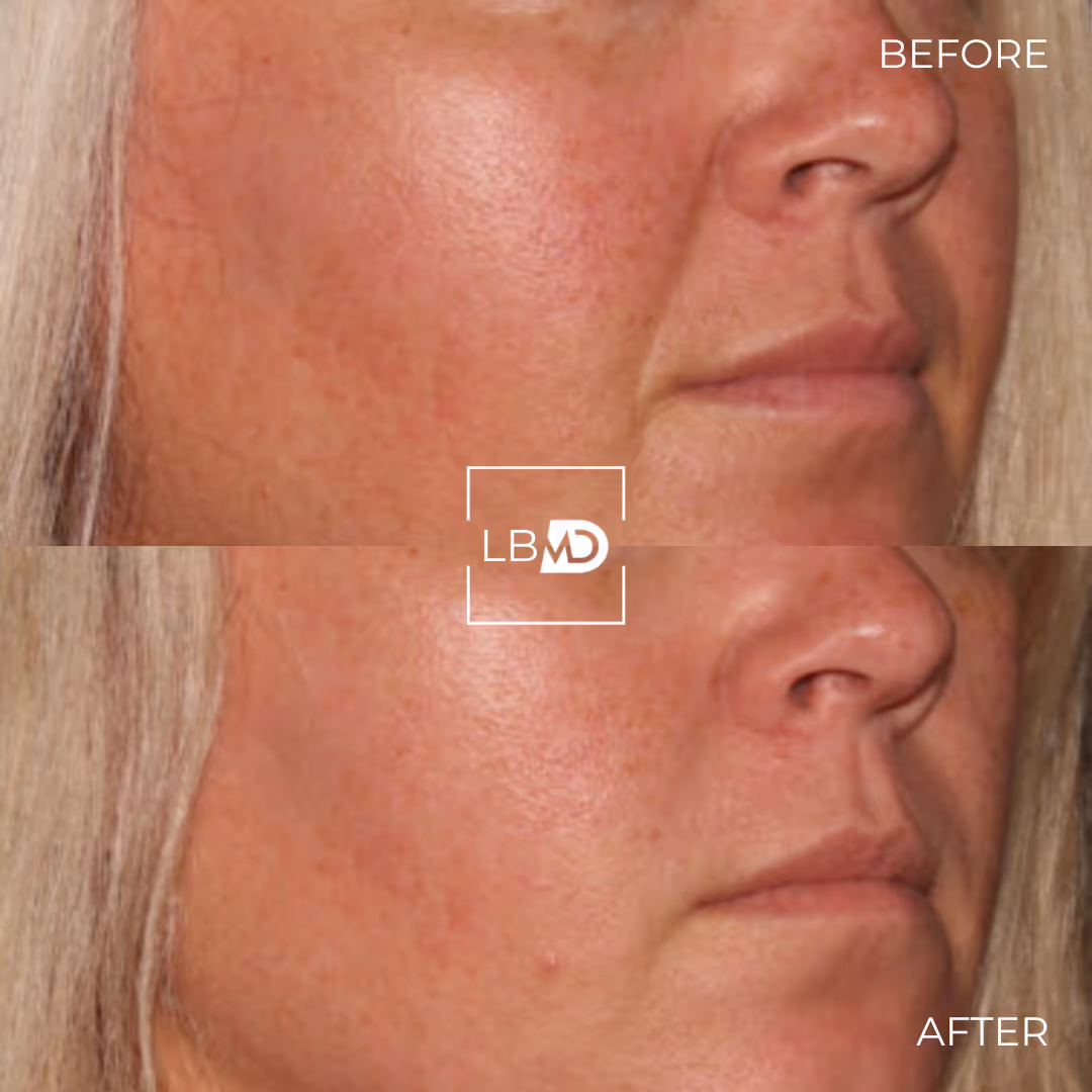 laser hair removal before and after