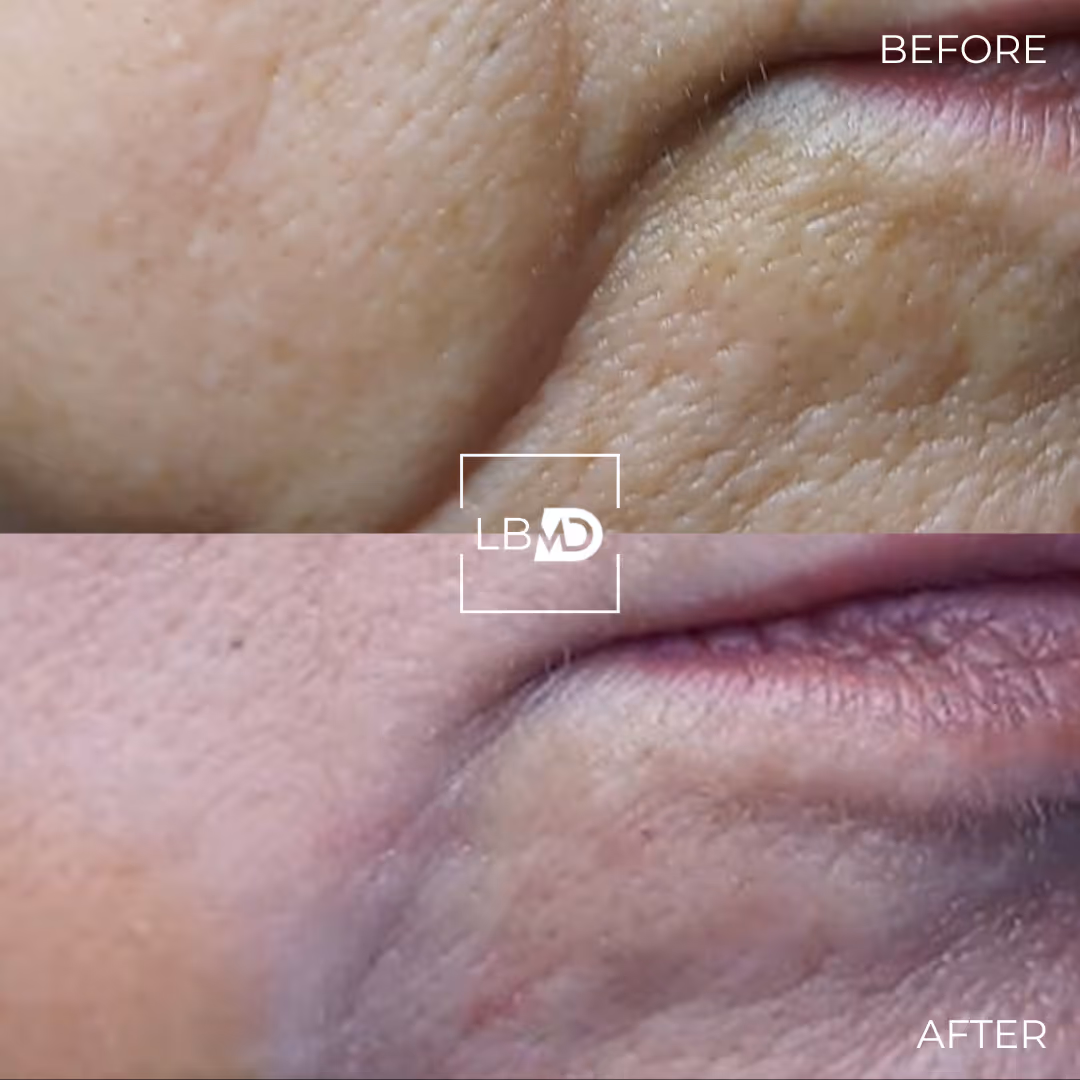 laser hair removal before and after