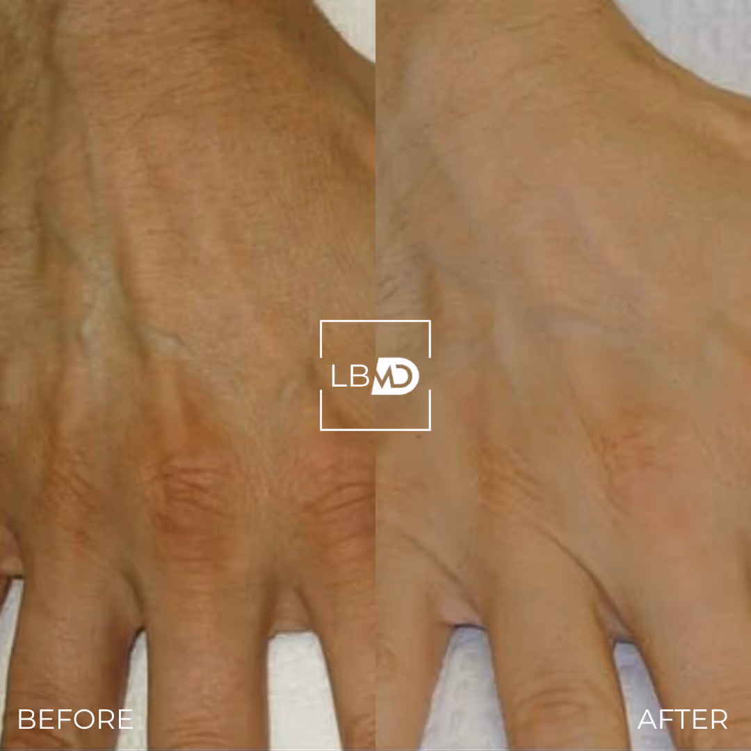 hand dermal filler before and after