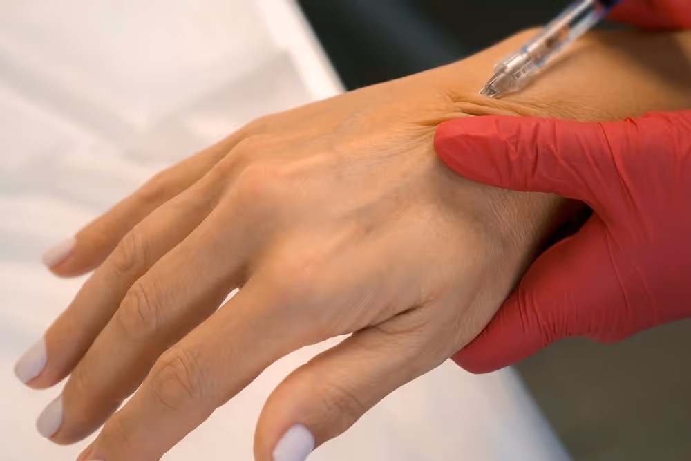 dermal filler for hands