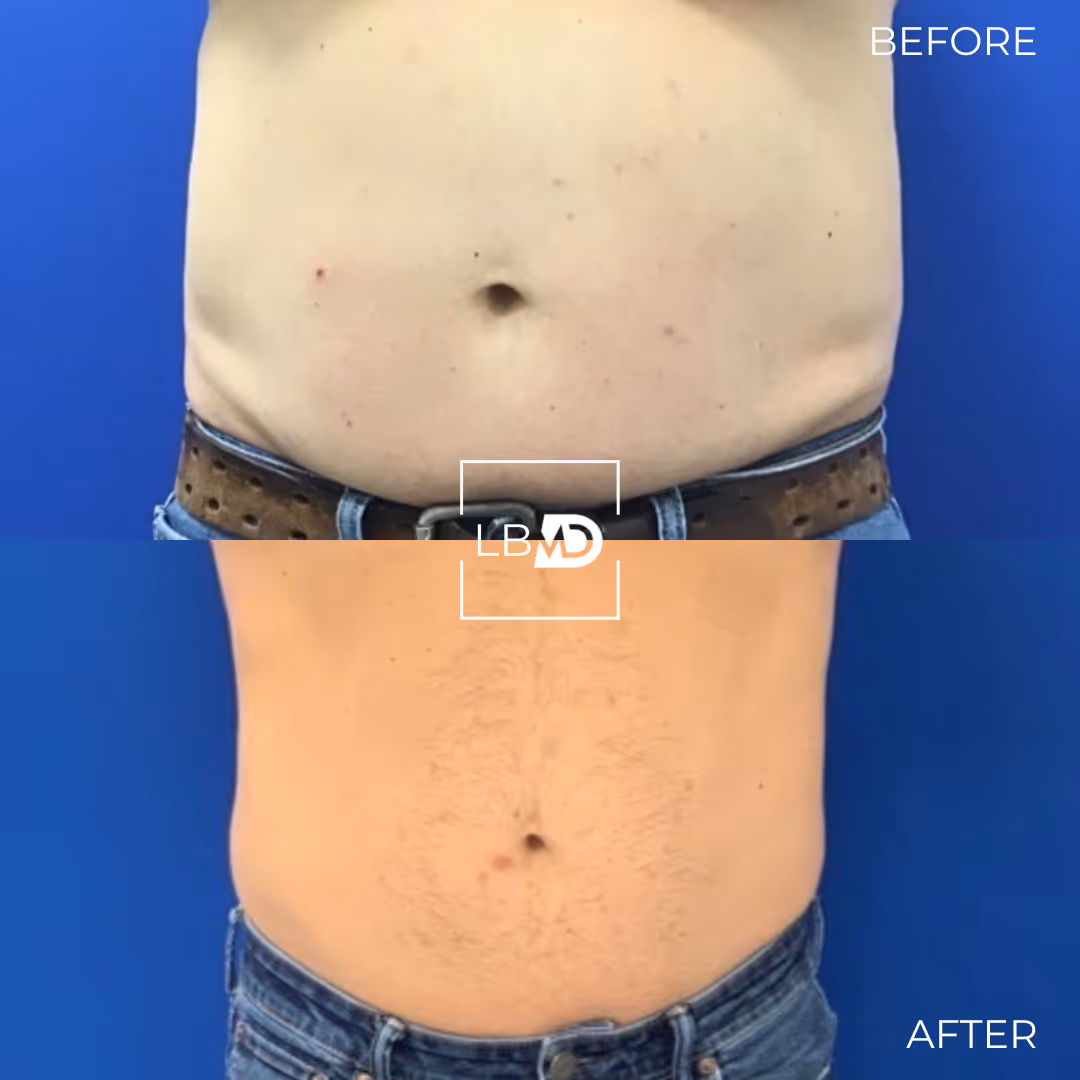 Botox before afterr