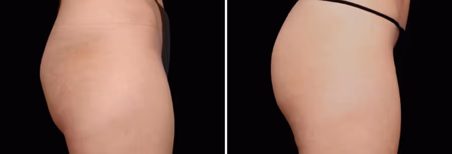 buttocks emsculpt before and after