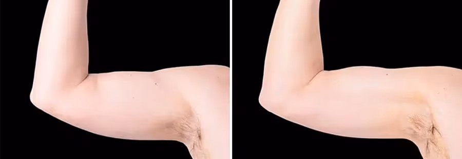 arms emsculpt before and after