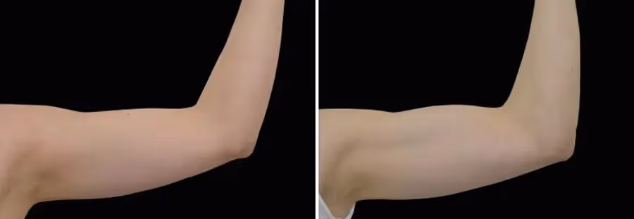 arms emsculpt before and after