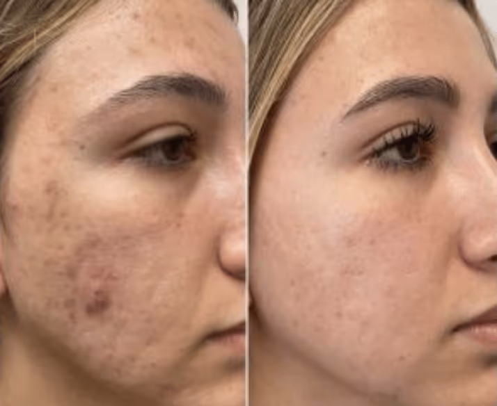 morpheus8 before and after
