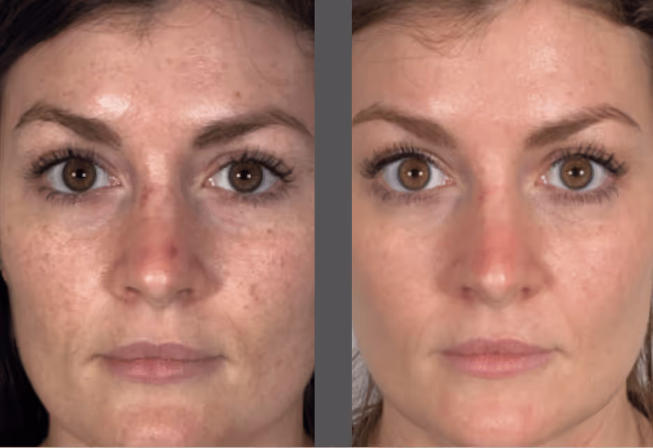 morpheus8 before and after