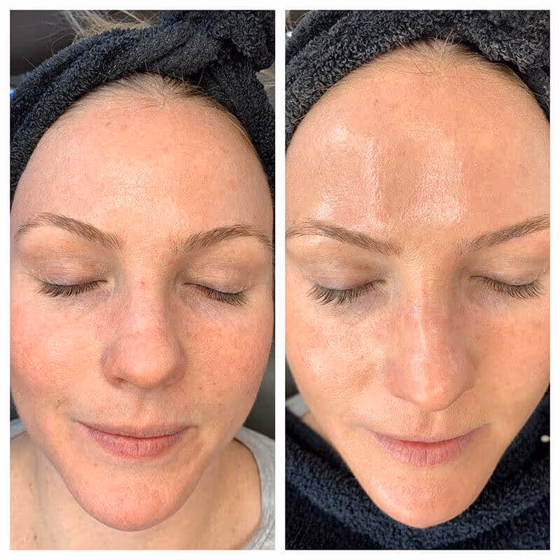 hydrafacial before and after