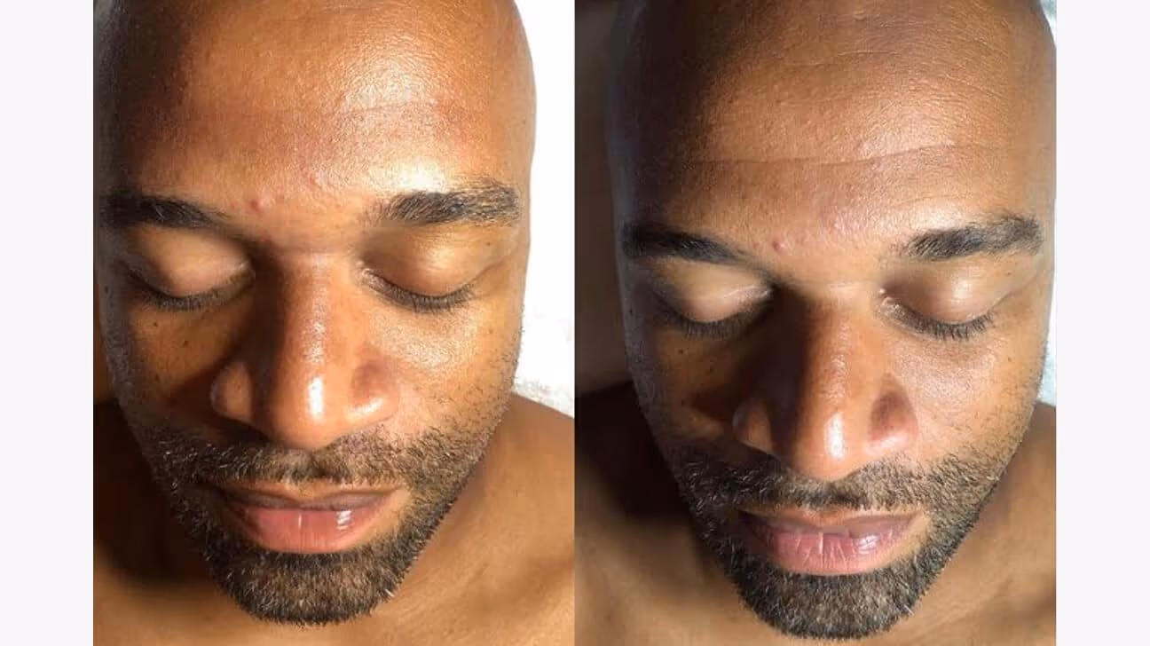hydrafacial before and after