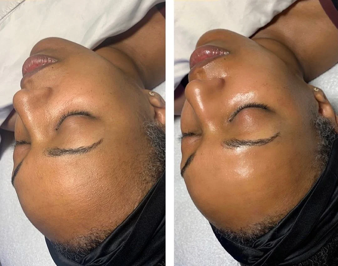 hydrafacial before and after