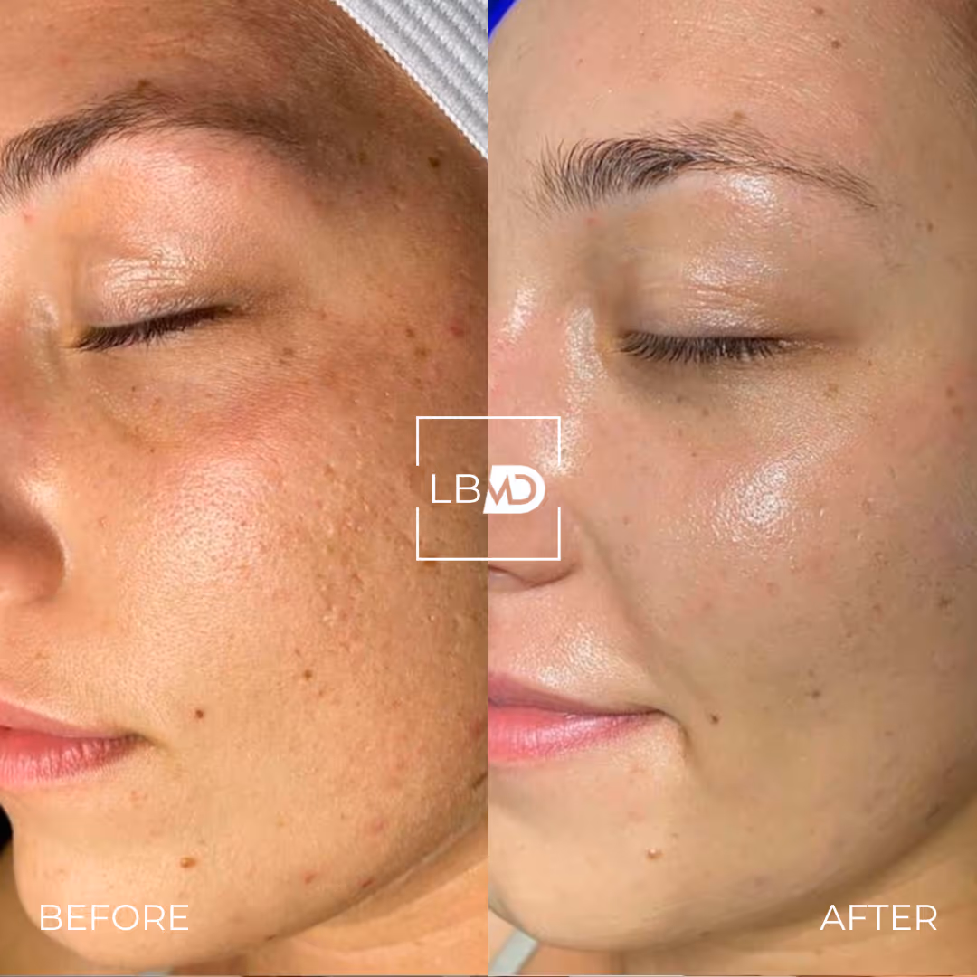 hydrafacial before and after