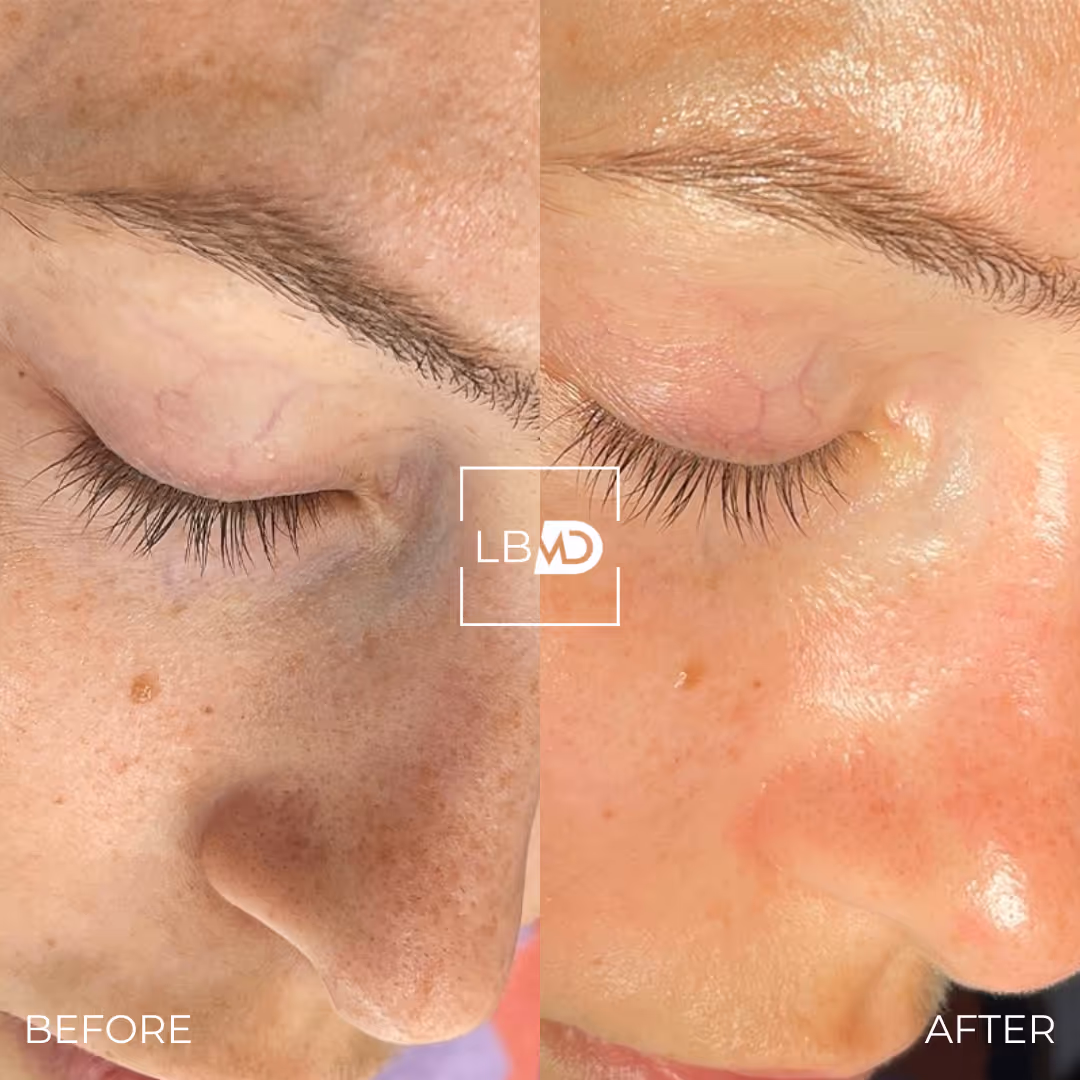 hydrafacial before and after