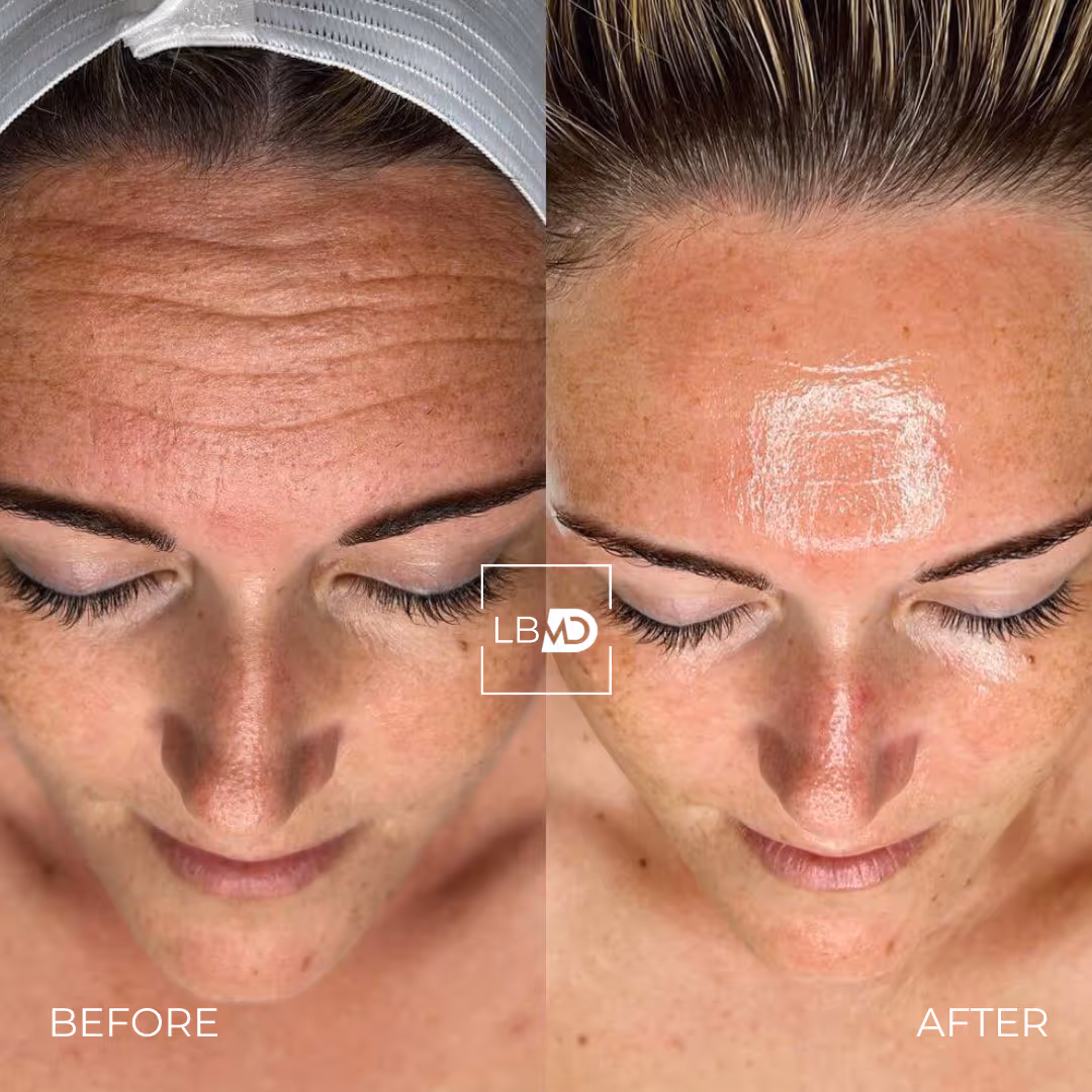 hydrafacial before and after