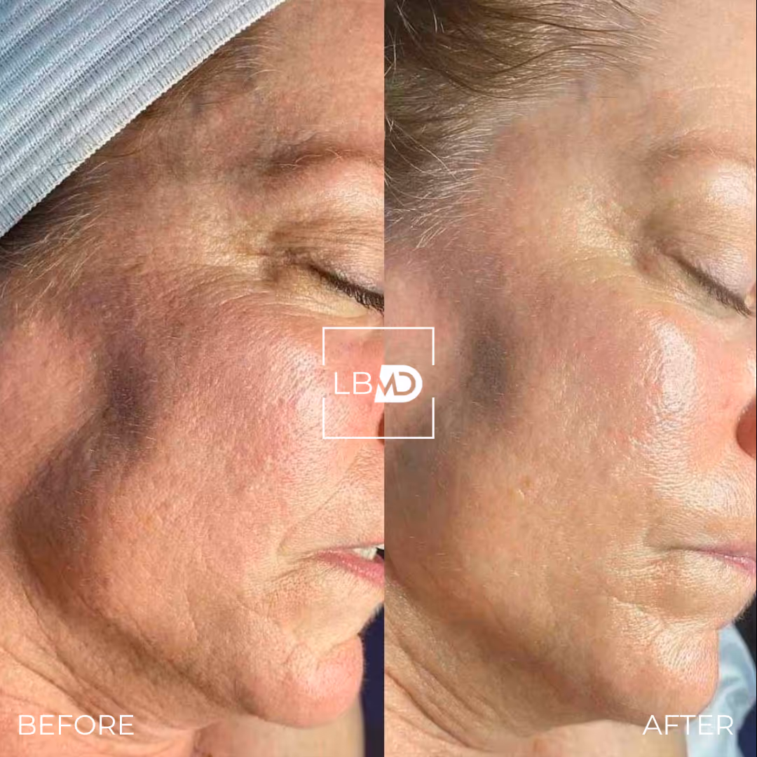 hydrafacial before and after