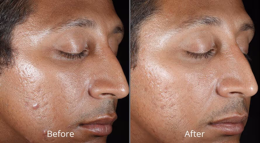 chemical peels before and after