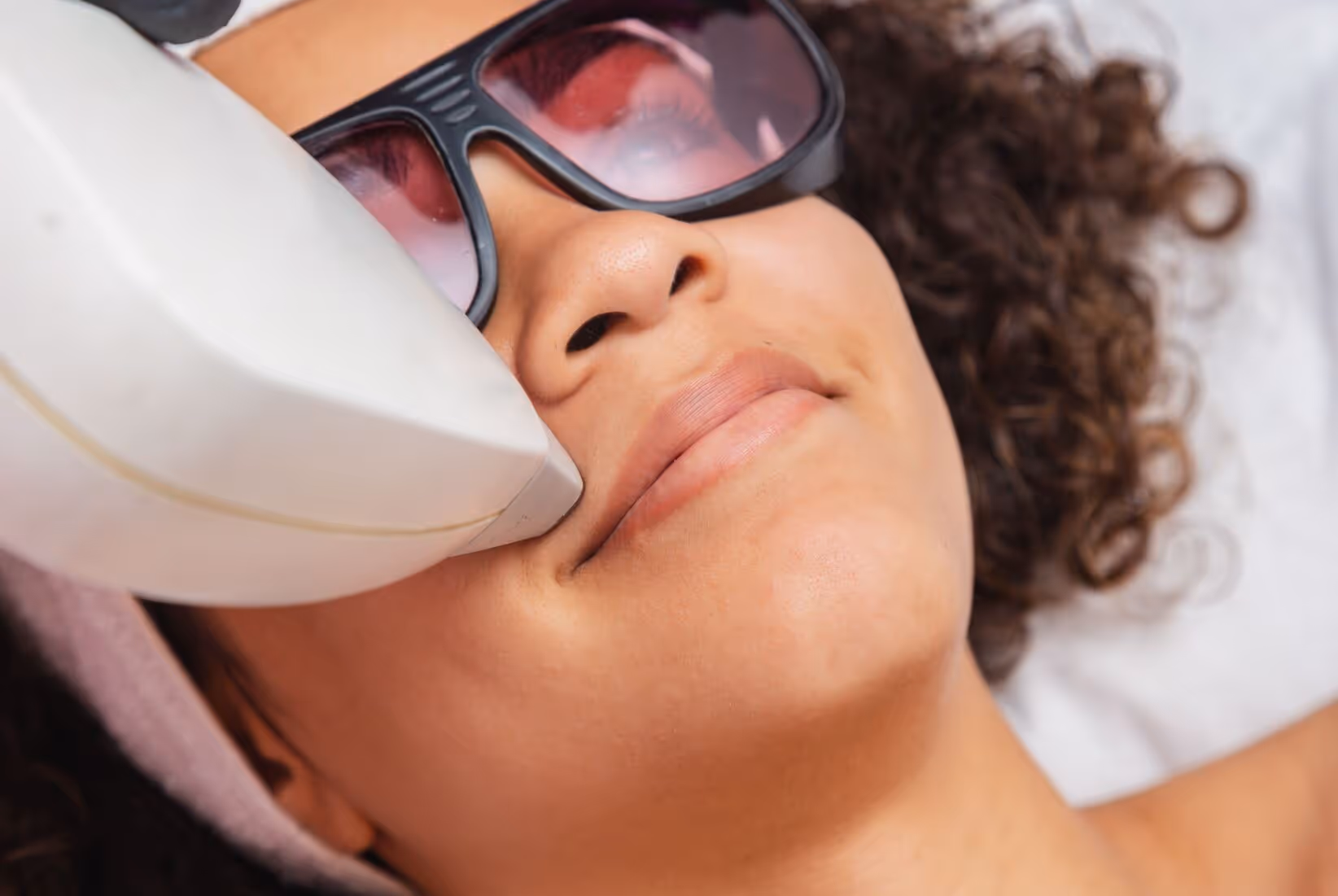 laser hair removal upper lip toronto