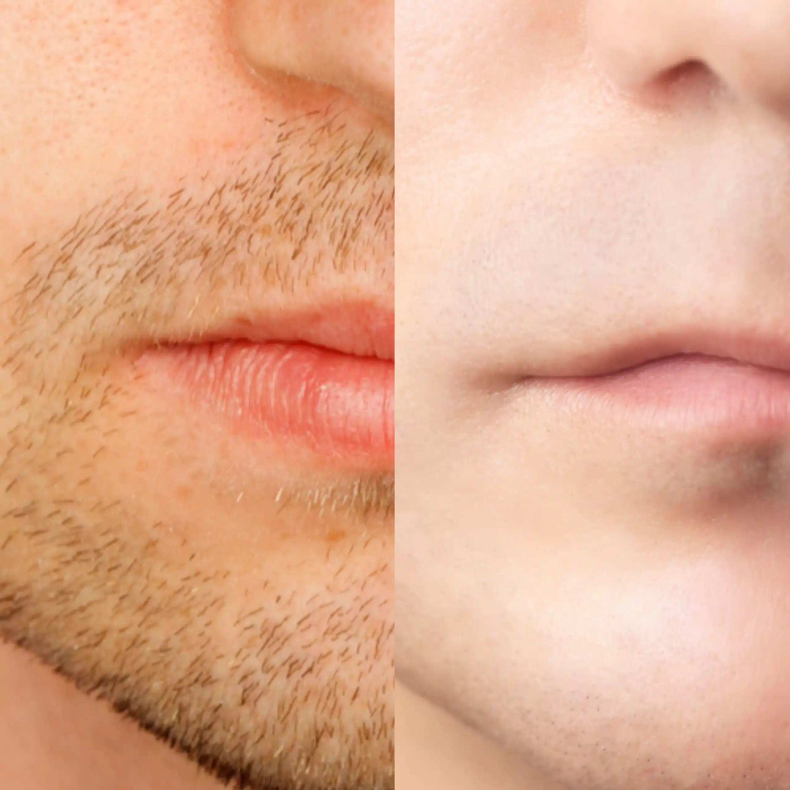 laser hair removal upper lip before and after