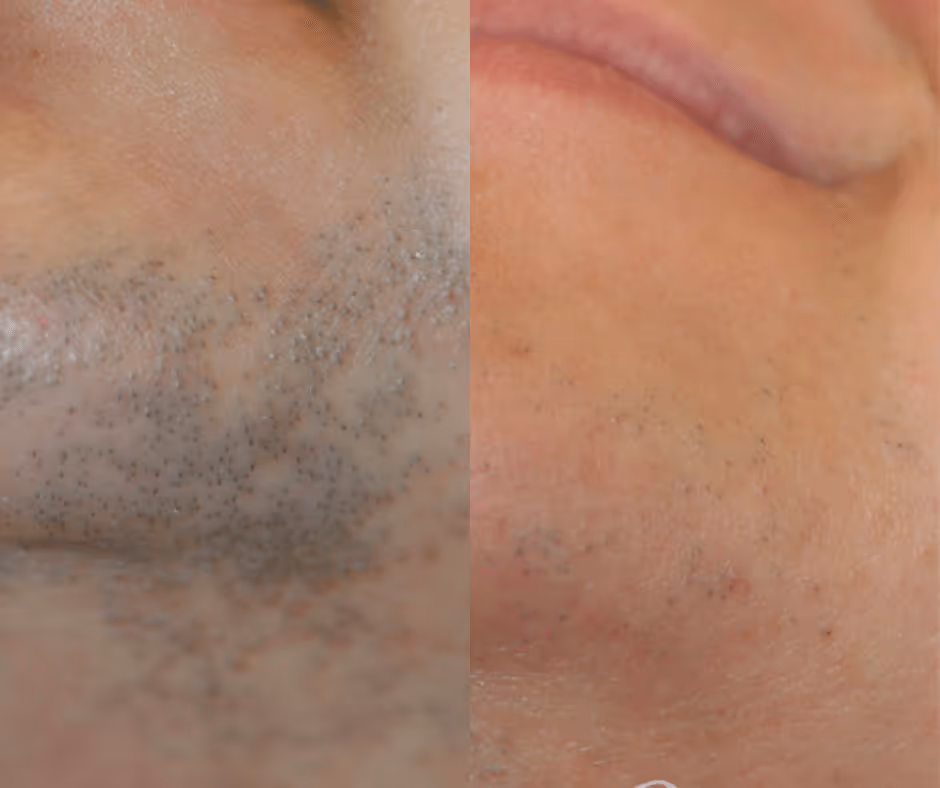 laser hair removal chin before and after