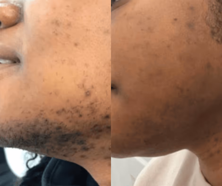 laser hair removal chin before and after