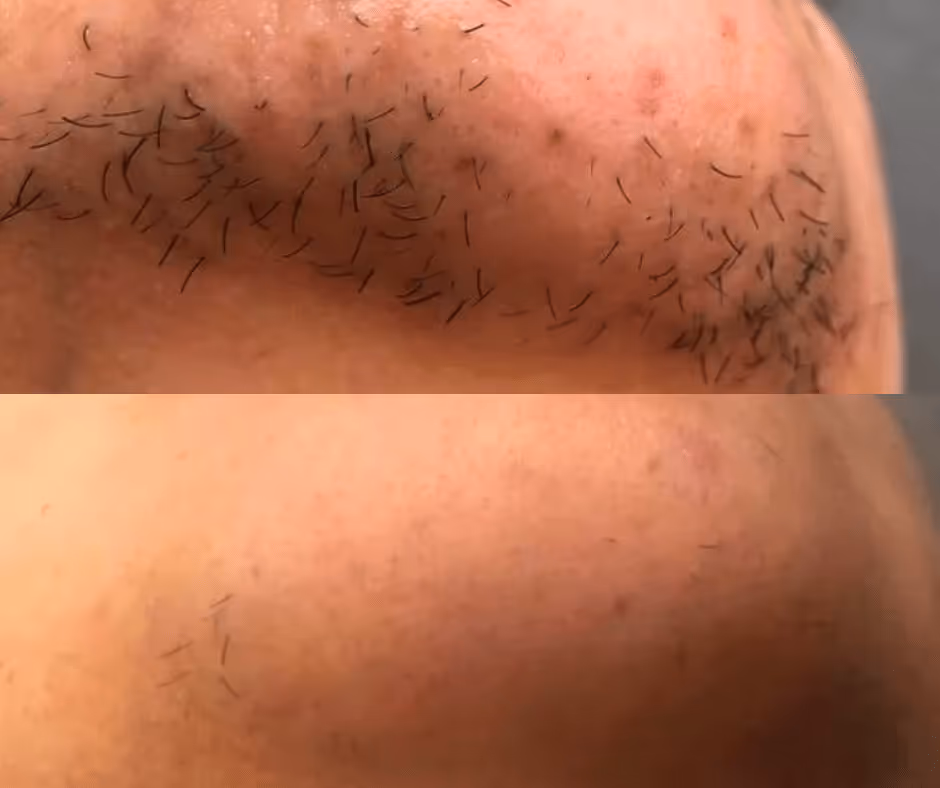 laser hair removal chin before and after