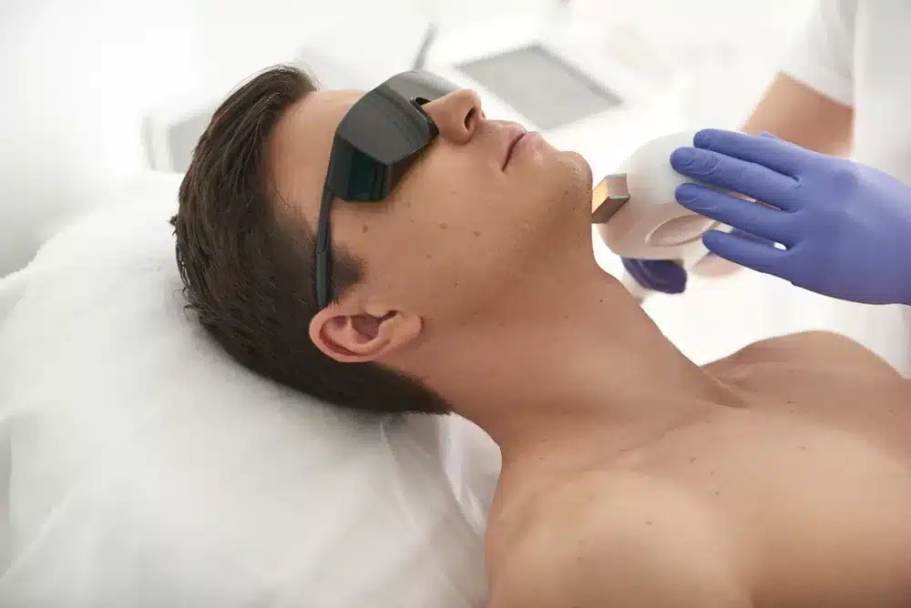 chin laser hair removal for men