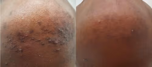 laser hair removal dark skin before and after