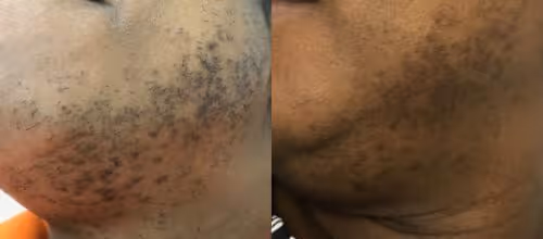 laser hair removal dark skin before and after