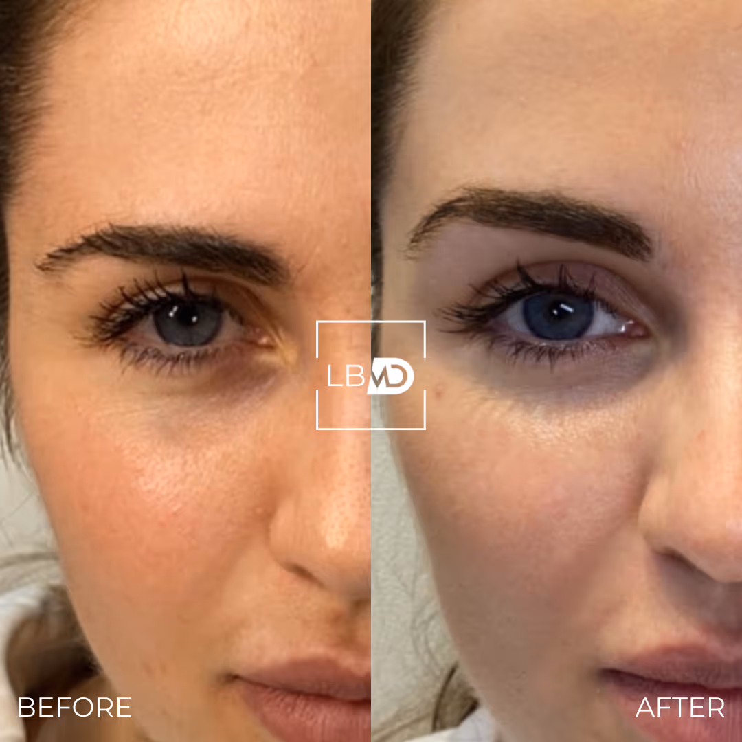  botox brow lift before and after