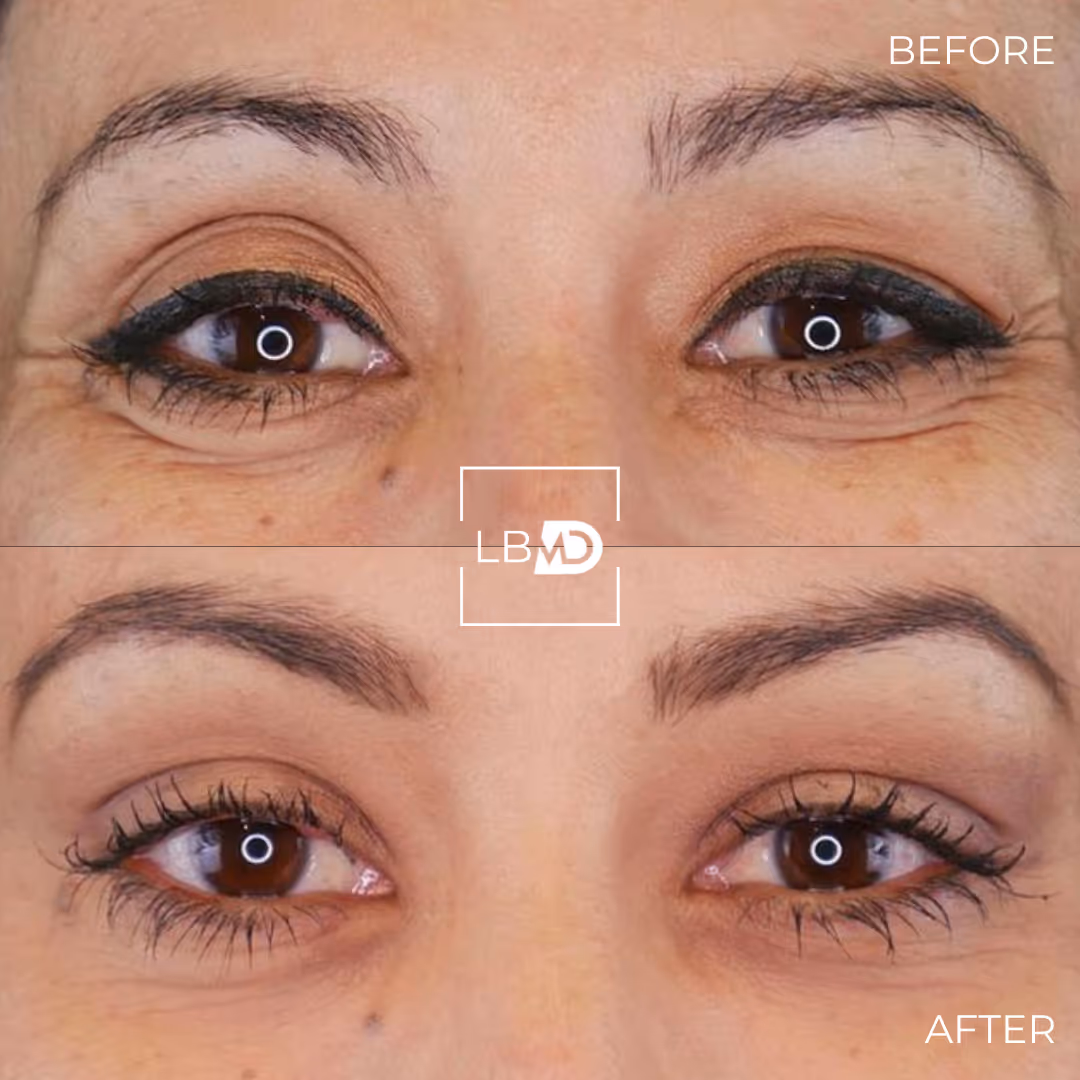 botox bunny line before and after