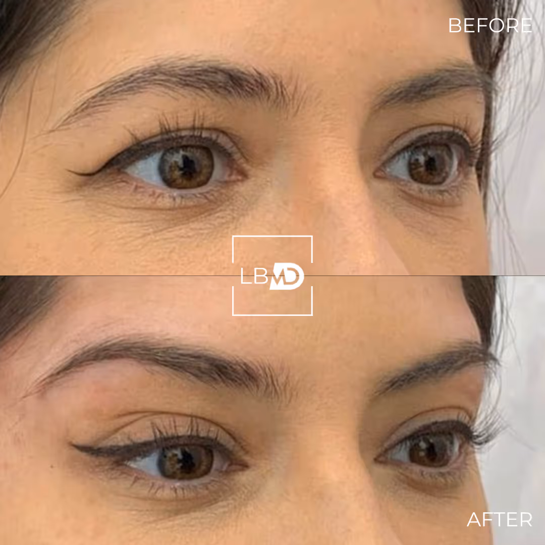 botox brow lift before and after