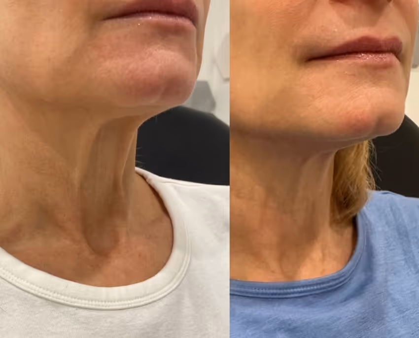 botox neck before and after