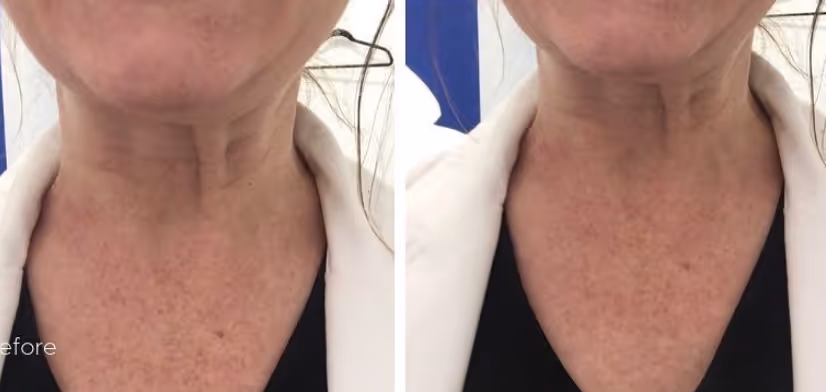botox neck before and after