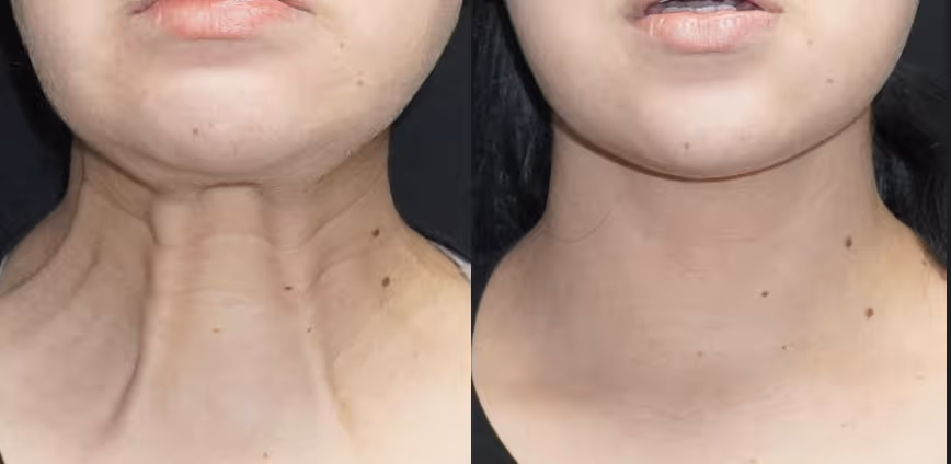 neck bands botox before and after