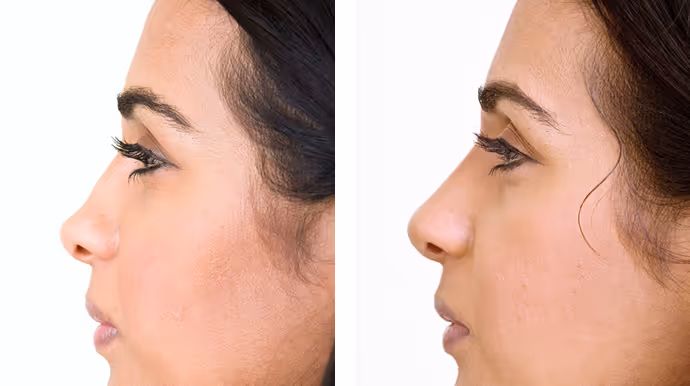 nose flip botox before and after