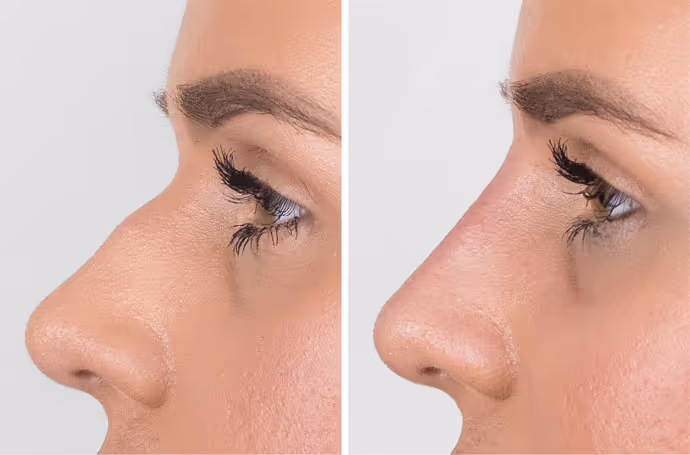 botox nose before and after