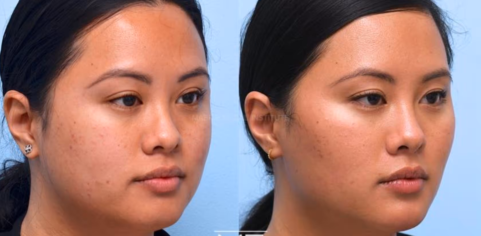 botox masseters before and after