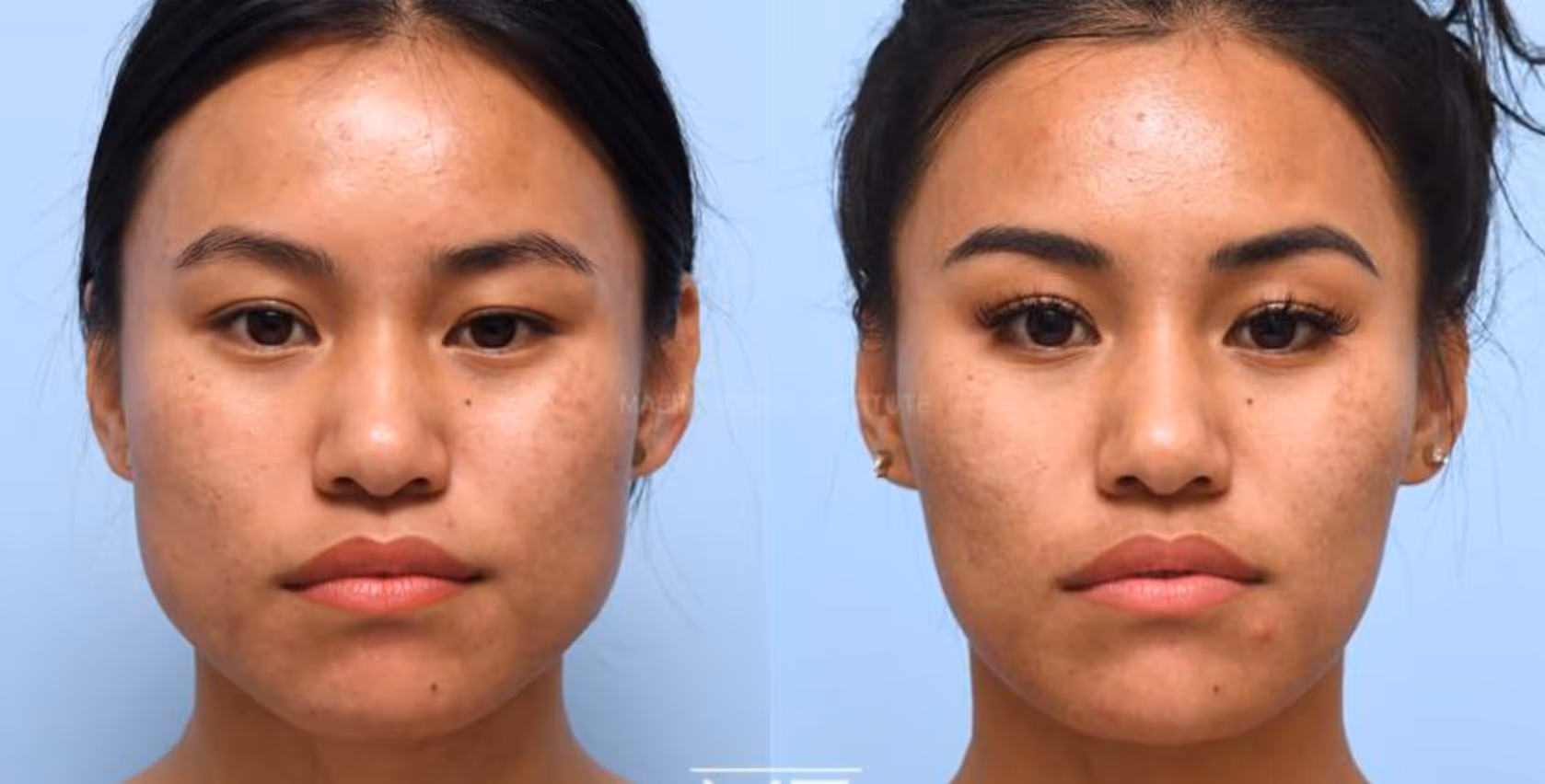 botox masseters before and after