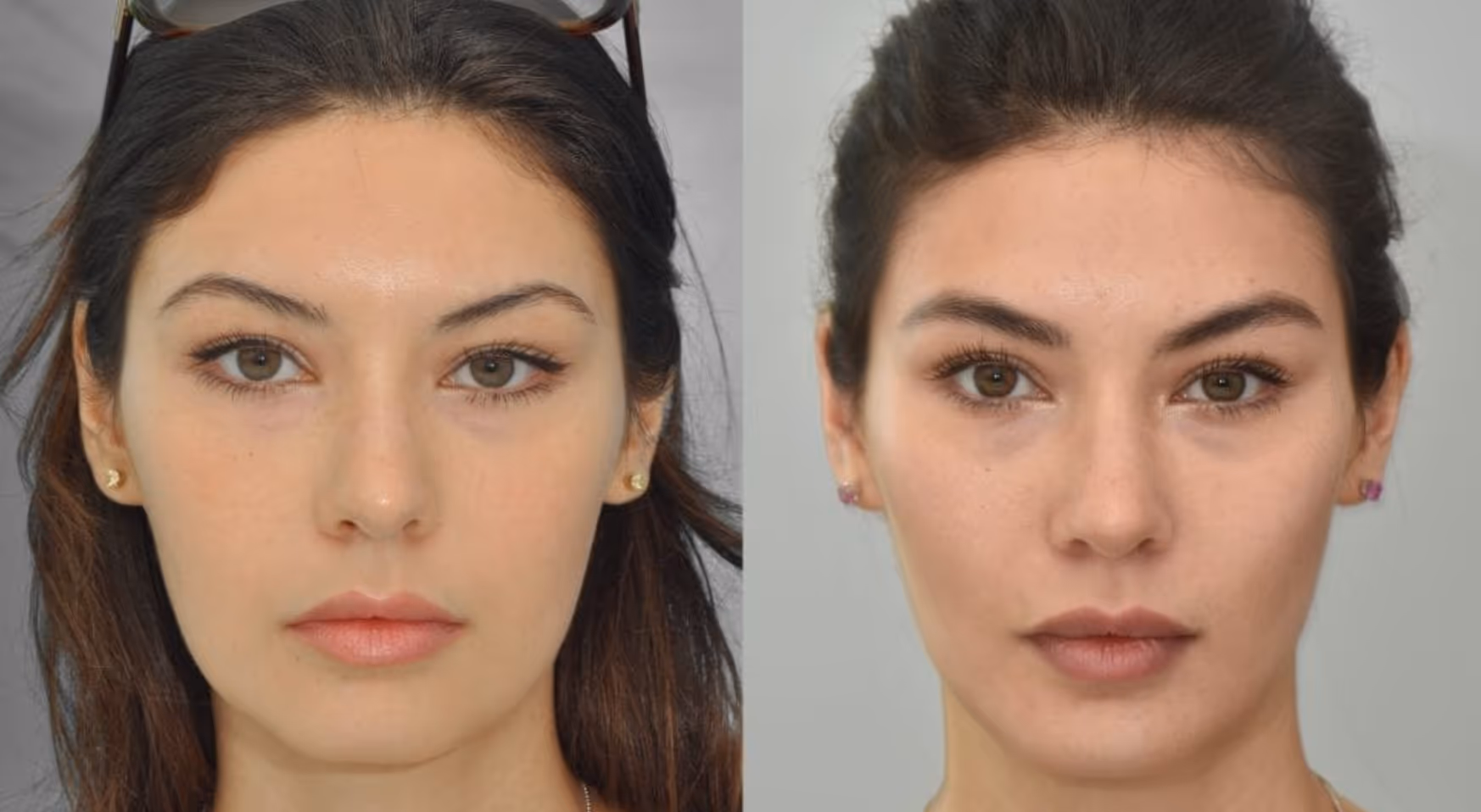 botox masseters before and after