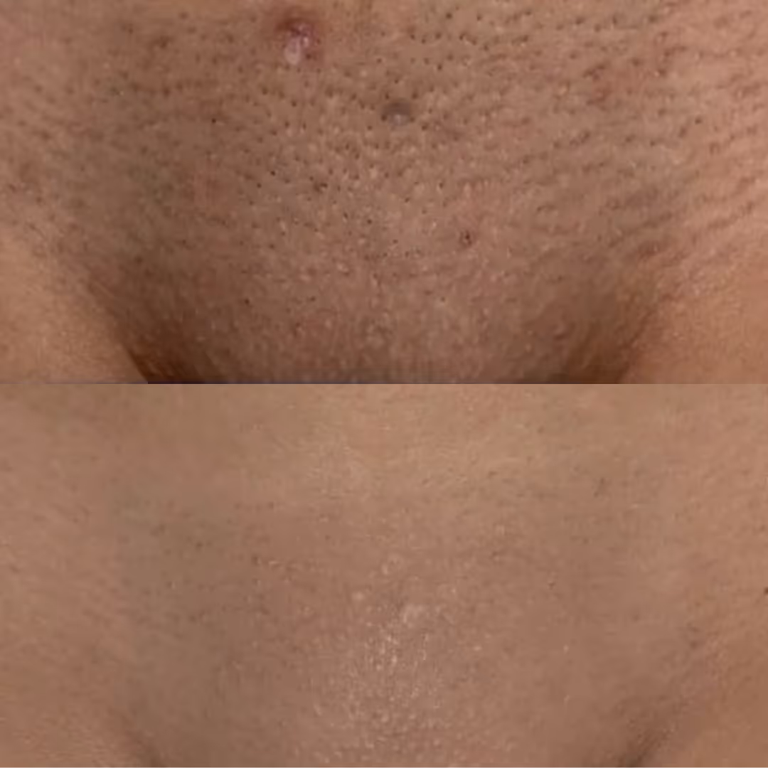 brazilian laser hair removal before and after