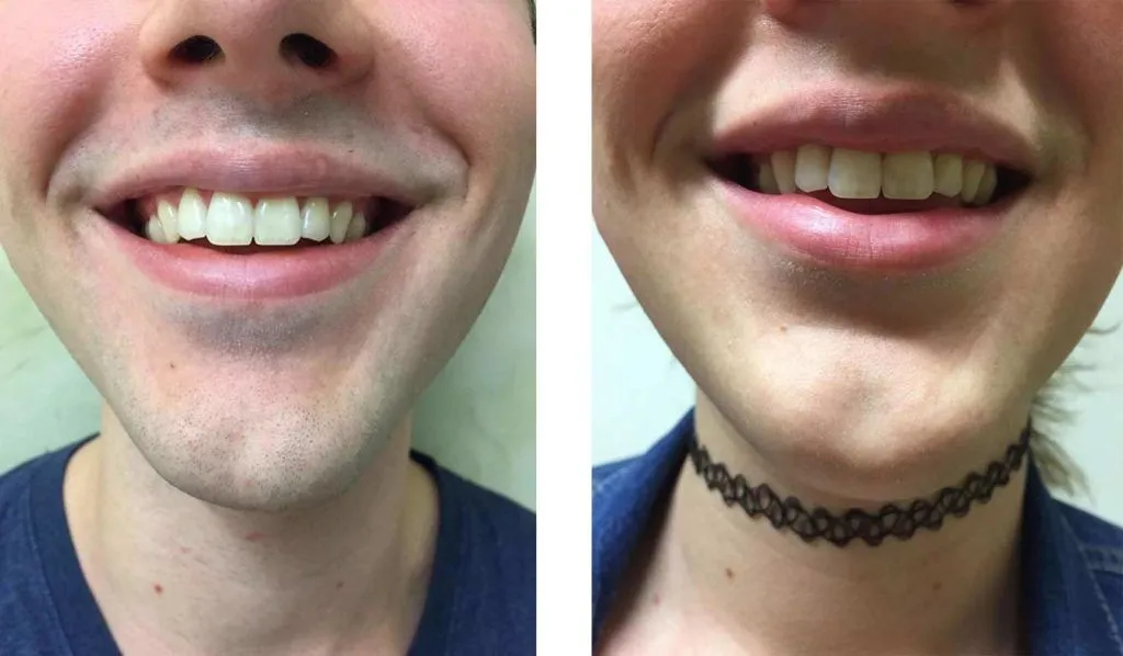 laser hair removal for transgender