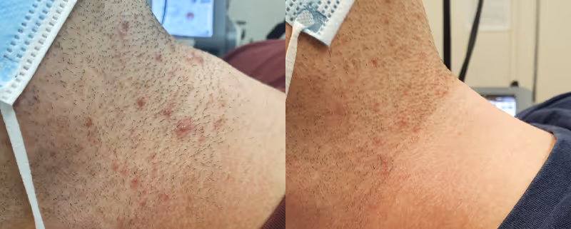laser hair removal for folliculitis before and after