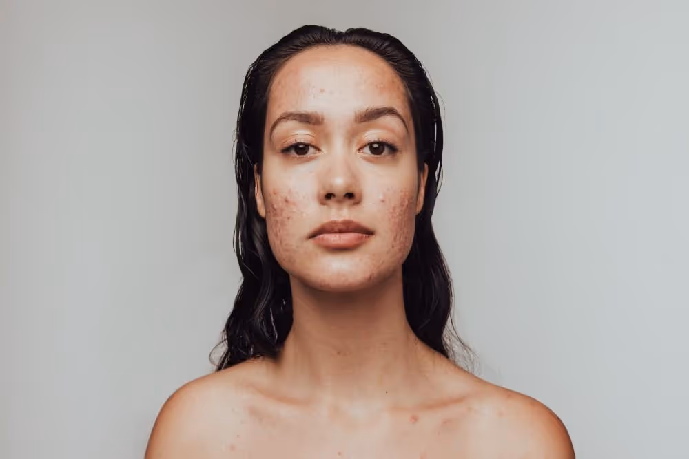laser hair removal for folliculitis