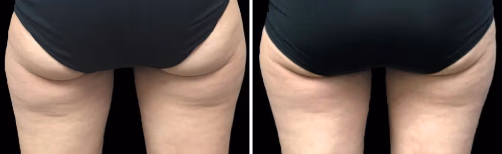 coolsculpting banana rolls